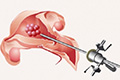 Гистероскопия, биопсия эндометрия